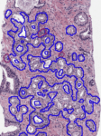 Digital pathology in ai being used as a qc check with tumor circled